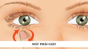 Mắt phải giật