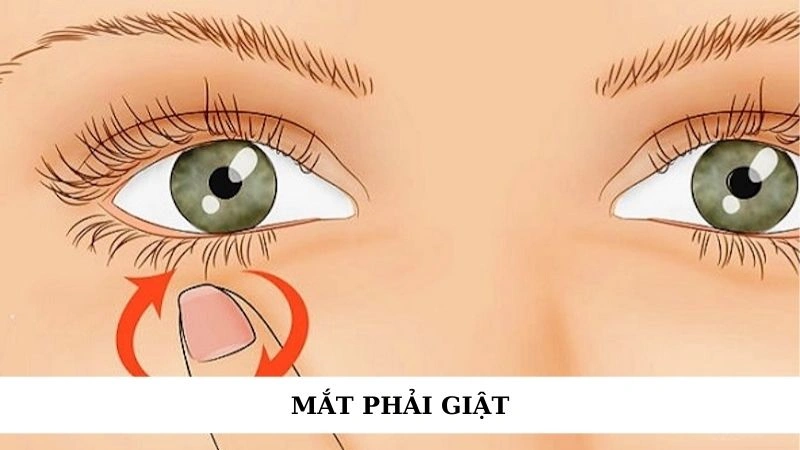Mắt phải giật